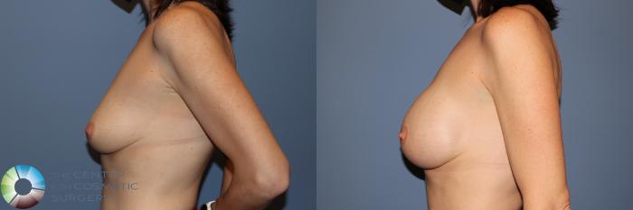 Before & After Breast Augmentation Case 11911 Left Side in Denver and Colorado Springs, CO