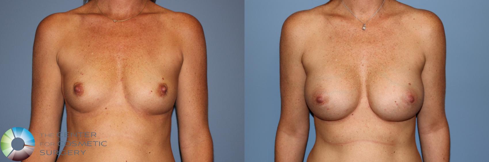 Before & After Breast Augmentation Case 11912 Front View in Golden, CO
