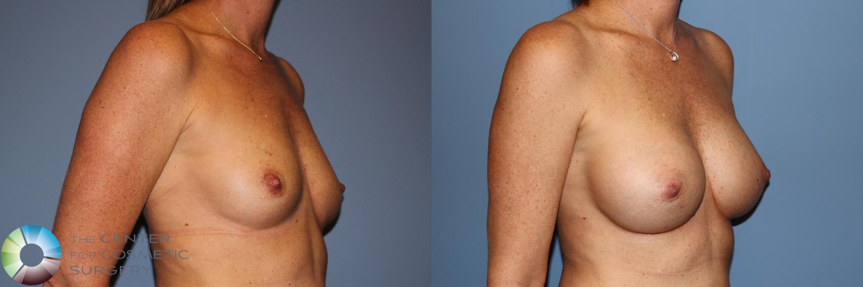 Before & After Breast Augmentation Case 11912 Right Oblique in Denver and Colorado Springs, CO