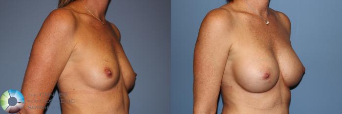 Before & After Breast Augmentation Case 11912 Right Oblique View in Golden, CO