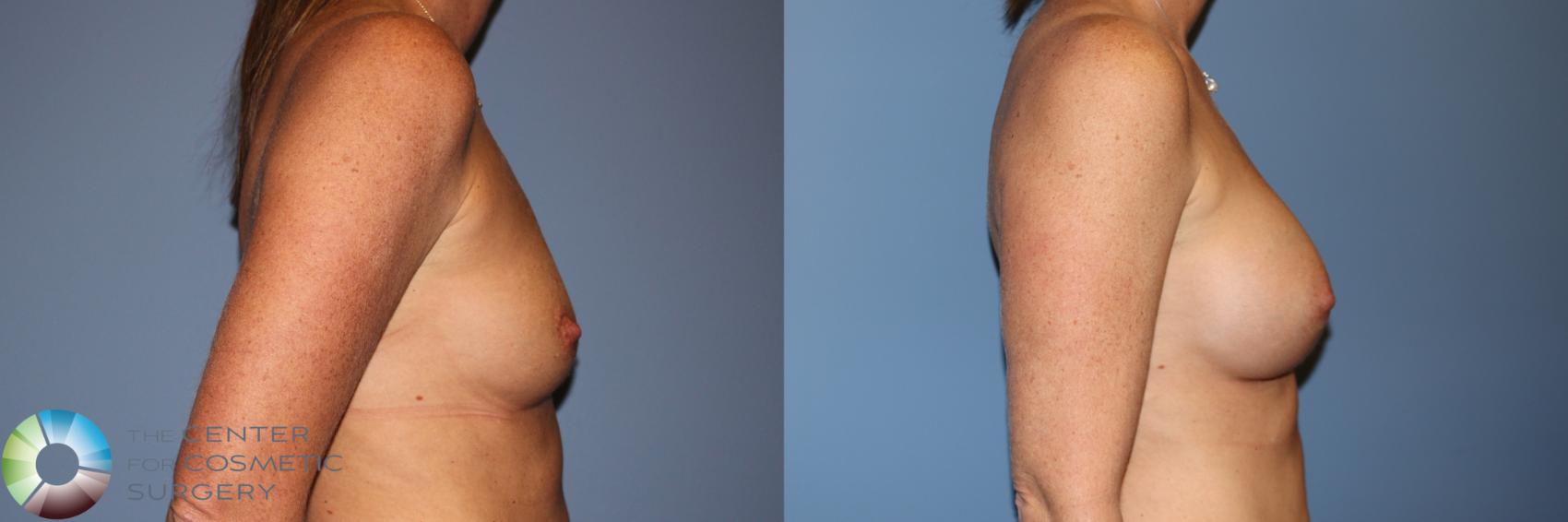 Before & After Breast Augmentation Case 11912 Right Side in Denver and Colorado Springs, CO