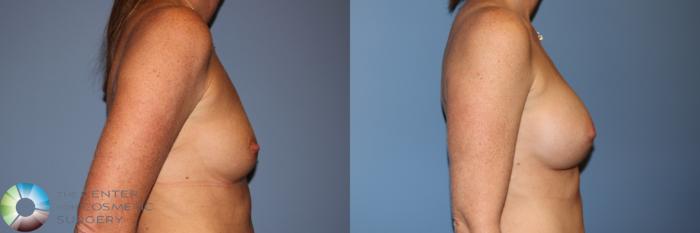Before & After Breast Augmentation Case 11912 Right Side View in Golden, CO