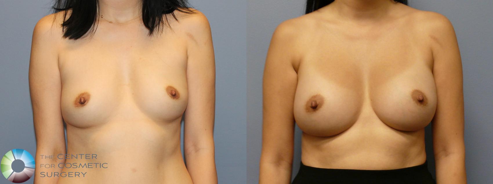 Before & After Breast Augmentation Case 11916 Front in Denver and Colorado Springs, CO