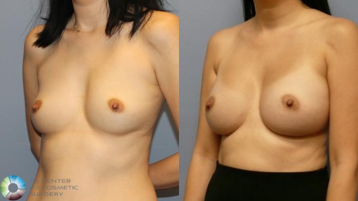 Before & After Breast Augmentation Case 11916 Left Oblique in Denver and Colorado Springs, CO