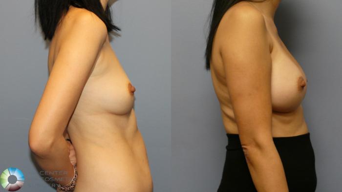 Before & After Breast Augmentation Case 11916 Left Side in Denver and Colorado Springs, CO