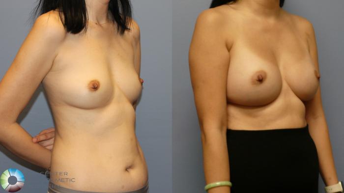 Before & After Breast Augmentation Case 11916 Right Oblique in Denver and Colorado Springs, CO