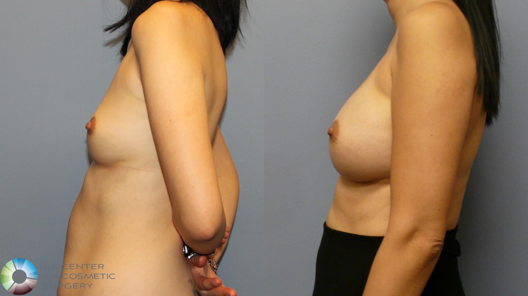 Before & After Breast Augmentation Case 11916 Right Side in Denver and Colorado Springs, CO