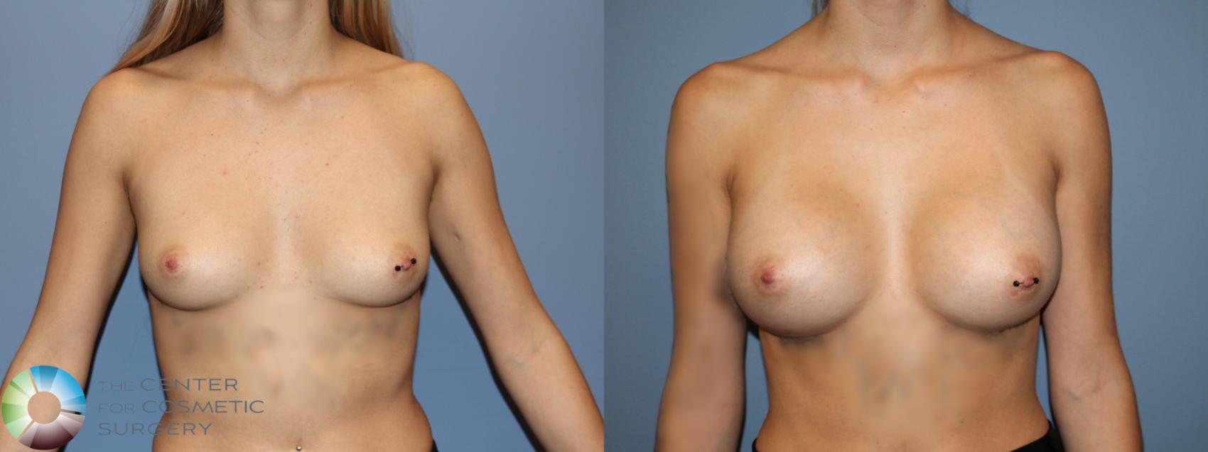 Before & After Breast Augmentation Case 11917 Front in Denver and Colorado Springs, CO