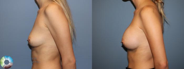 Before & After Breast Augmentation Case 11917 Left Side in Denver and Colorado Springs, CO