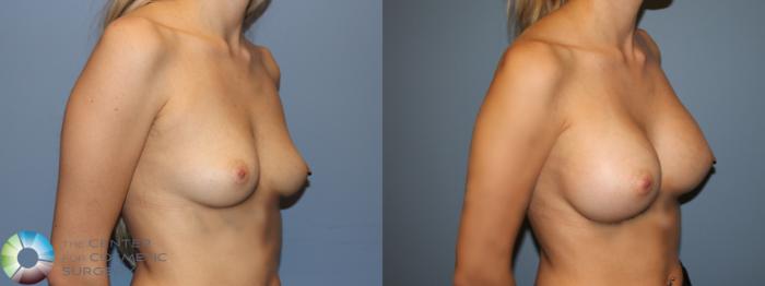 Before & After Breast Augmentation Case 11917 Right Oblique in Denver and Colorado Springs, CO