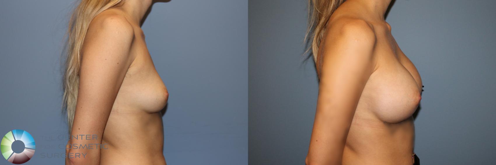 Before & After Breast Augmentation Case 11917 Right Side in Denver and Colorado Springs, CO