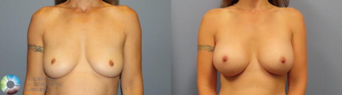 Before & After Breast Augmentation Case 11920 Front View in Golden, CO