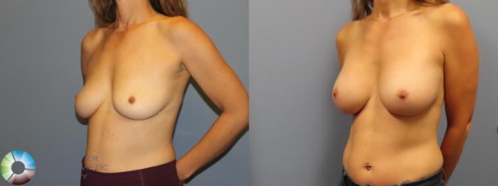 Before & After Breast Augmentation Case 11920 Left Oblique View in Golden, CO