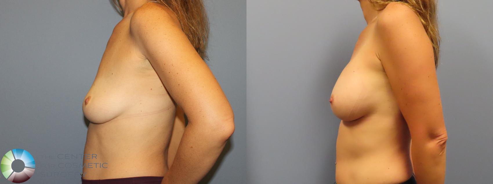 Before & After Breast Augmentation Case 11920 Left Side in Denver and Colorado Springs, CO