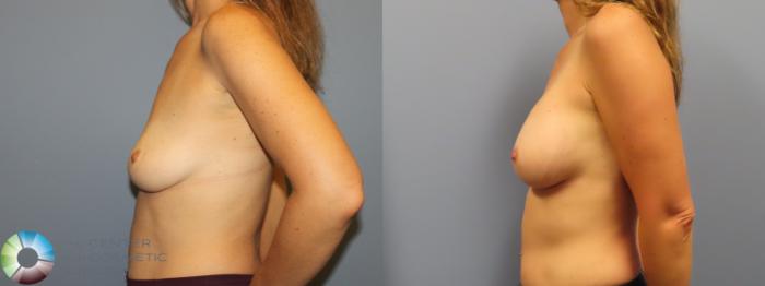 Before & After Breast Augmentation Case 11920 Left Side View in Golden, CO