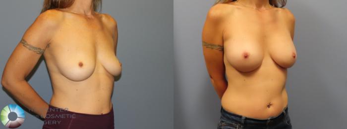 Before & After Breast Augmentation Case 11920 Right Oblique View in Golden, CO