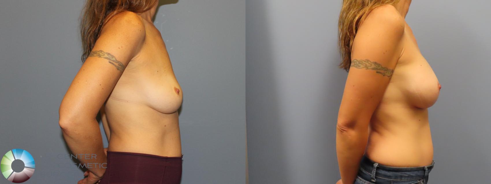 Before & After Breast Augmentation Case 11920 Right Side in Denver and Colorado Springs, CO