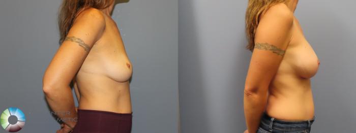 Before & After Breast Augmentation Case 11920 Right Side View in Golden, CO