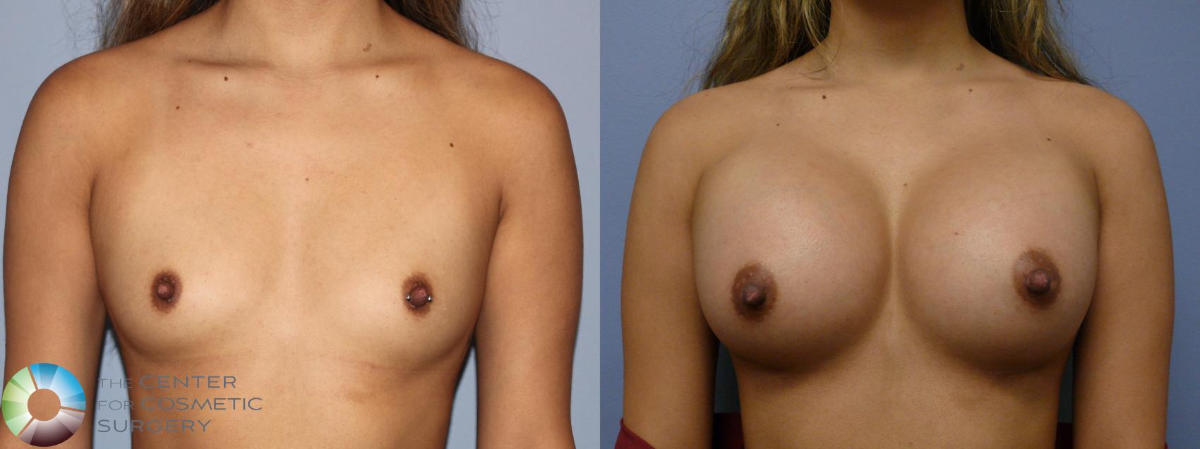 Before & After Breast Augmentation Case 11924 Front in Denver and Colorado Springs, CO