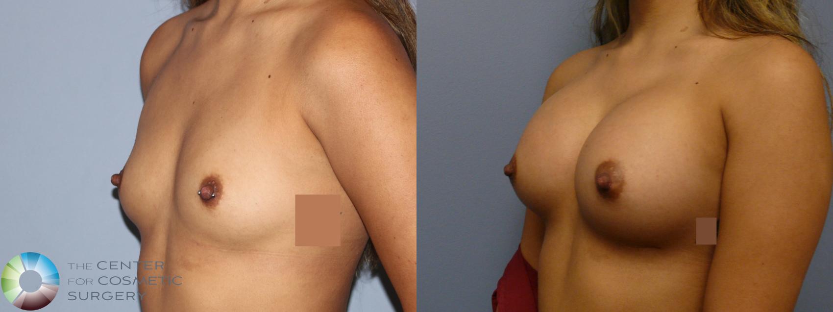 Before & After Breast Augmentation Case 11924 Left Oblique in Denver and Colorado Springs, CO