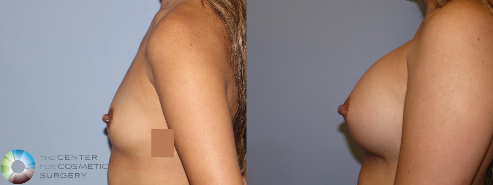 Before & After Breast Augmentation Case 11924 Left Side in Denver and Colorado Springs, CO