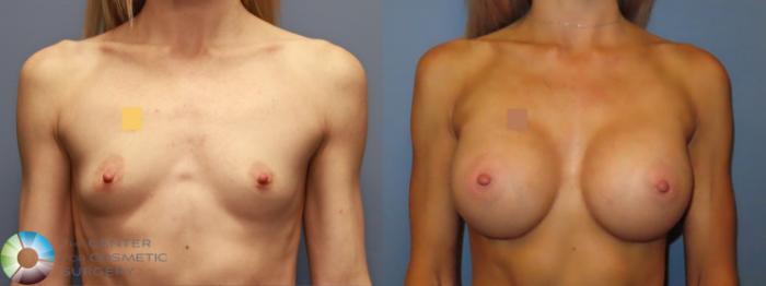 Before & After Breast Augmentation Case 11926 Front in Denver and Colorado Springs, CO