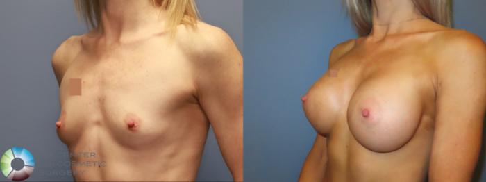 Before & After Breast Augmentation Case 11926 Left Oblique in Denver and Colorado Springs, CO