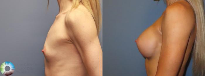 Before & After Breast Augmentation Case 11926 Left Side in Denver and Colorado Springs, CO