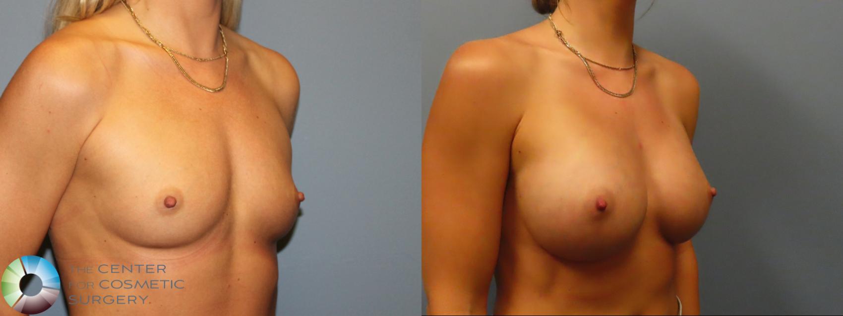 Before & After Breast Augmentation Case 11932 Right Oblique in Denver and Colorado Springs, CO