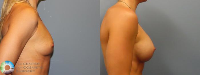 Before & After Breast Augmentation Case 11932 Right Side View in Golden, CO