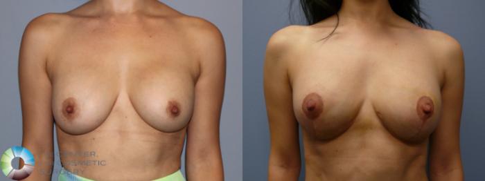 Before & After Breast Augmentation Case 11942 Front View in Golden, CO