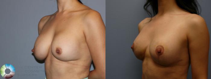 Before & After Breast Augmentation Case 11942 Left Oblique View in Golden, CO