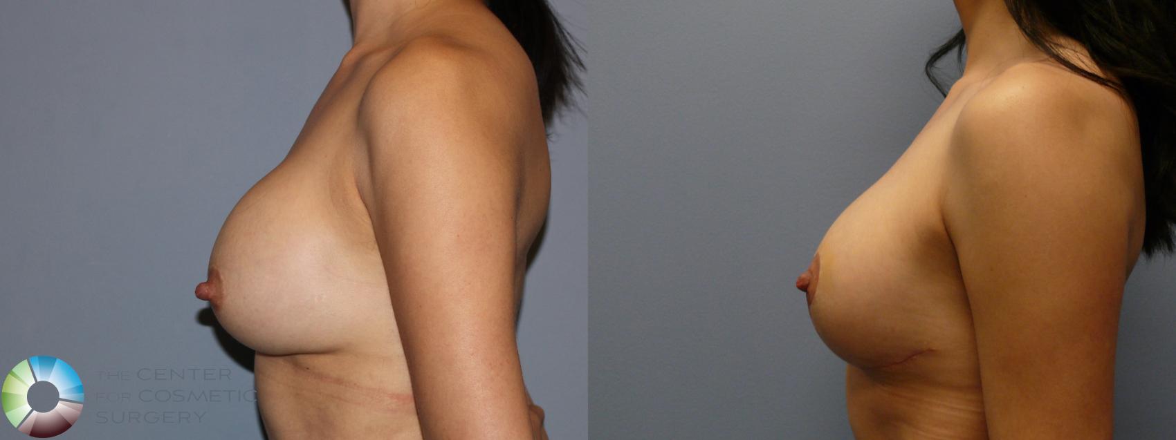 Before & After Breast Augmentation Case 11942 Left Side in Denver and Colorado Springs, CO