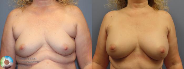 Before & After Breast Augmentation Case 11943 Front View in Golden, CO