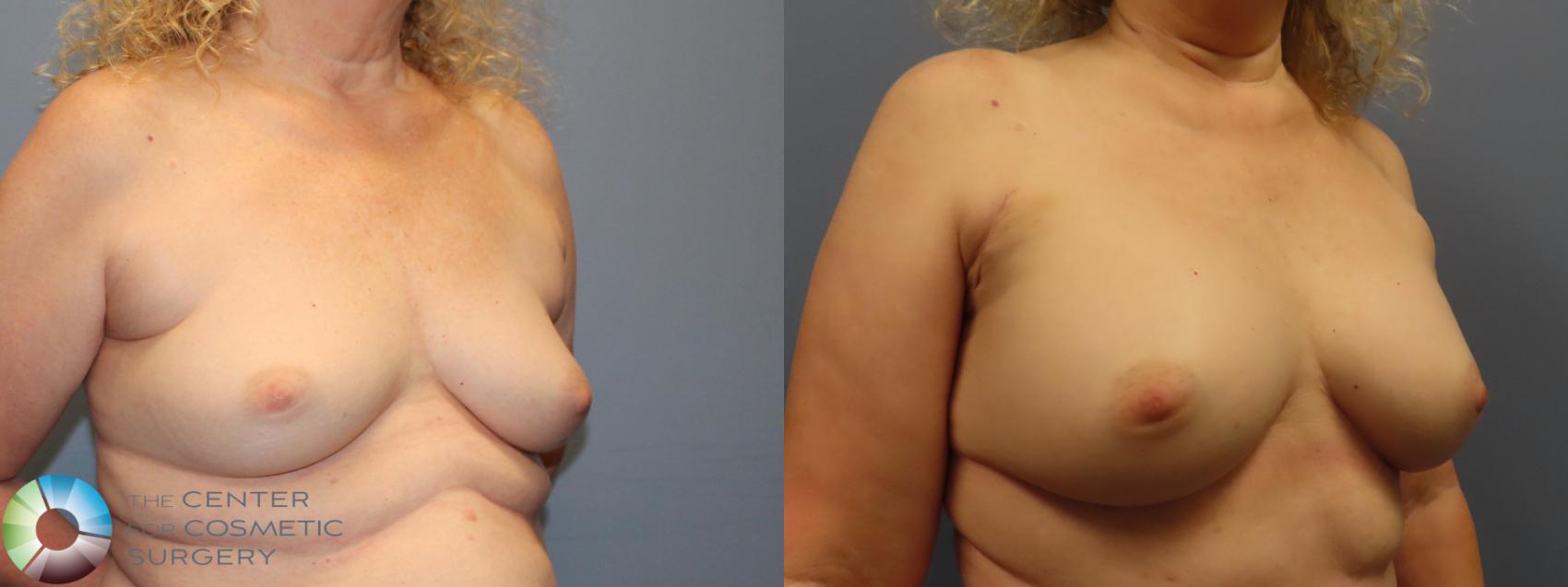 Before & After Breast Augmentation Case 11943 Left Oblique in Denver and Colorado Springs, CO