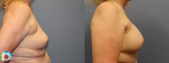 Before & After Breast Augmentation Case 11943 Left Side in Denver and Colorado Springs, CO