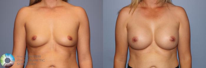 Before & After Breast Augmentation Case 11959 Front in Denver and Colorado Springs, CO