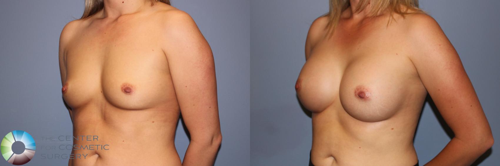 Before & After Breast Augmentation Case 11959 Left Oblique in Denver and Colorado Springs, CO