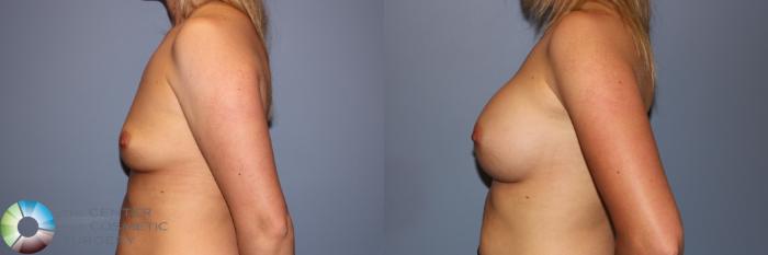 Before & After Breast Augmentation Case 11959 Left Side in Denver and Colorado Springs, CO