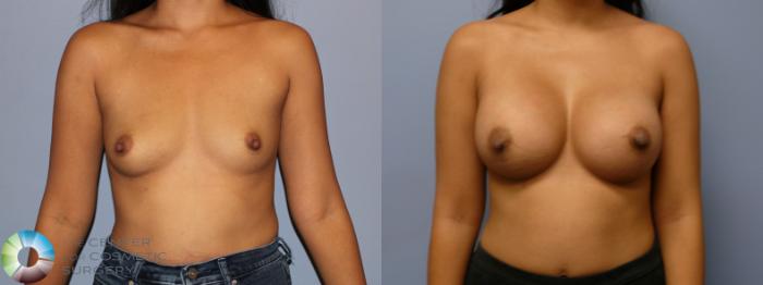 Before & After Breast Augmentation Case 11971 Front in Denver and Colorado Springs, CO