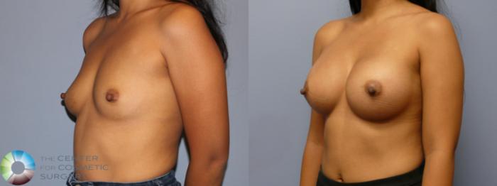 Before & After Breast Augmentation Case 11971 Left Oblique in Denver and Colorado Springs, CO