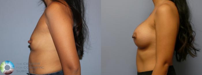 Before & After Breast Augmentation Case 11971 Left Side in Denver and Colorado Springs, CO