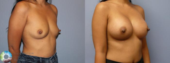 Before & After Breast Augmentation Case 11971 Right Oblique in Denver and Colorado Springs, CO