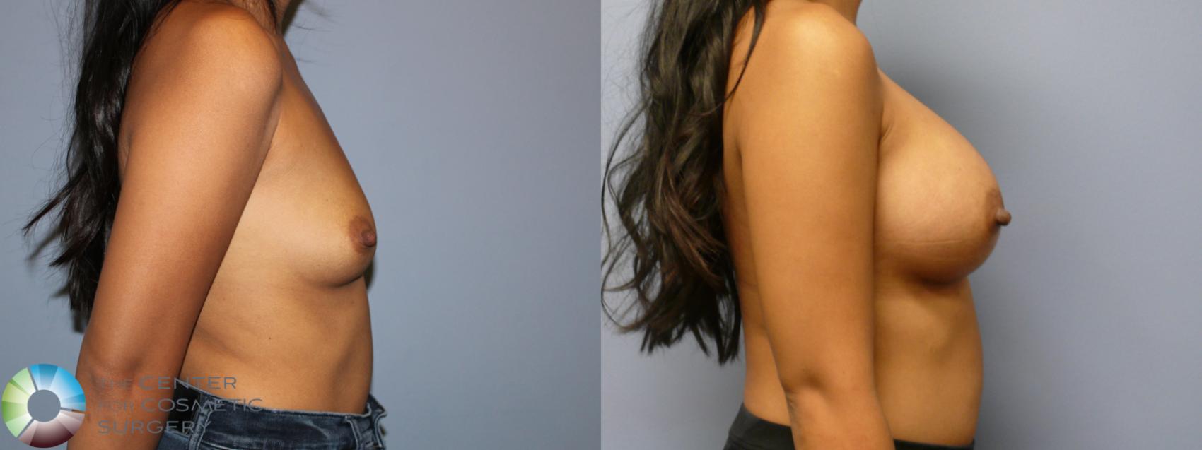 Before & After Breast Augmentation Case 11971 Right Side in Denver and Colorado Springs, CO