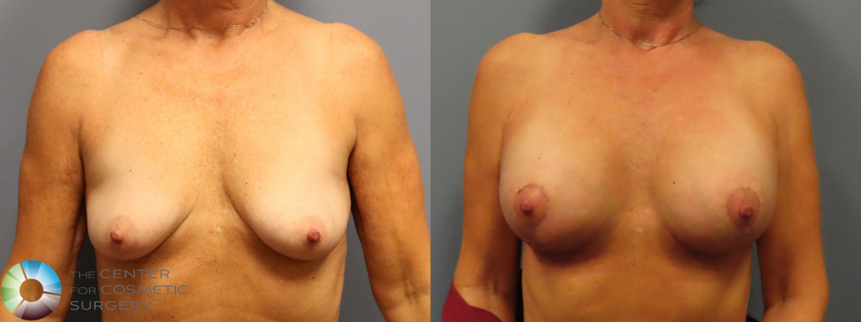 Best Denver Breast Lift/Augmentation