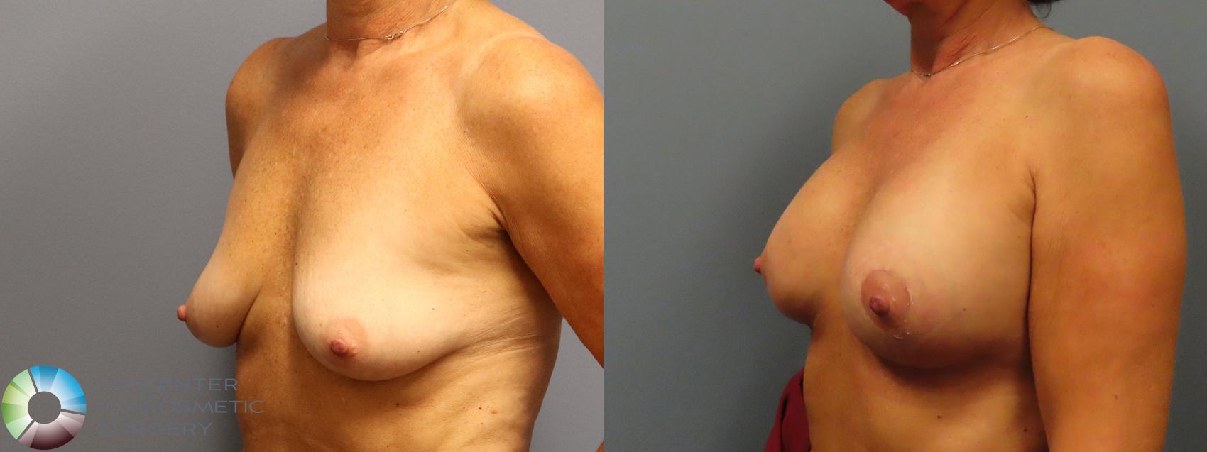 Before & After Breast Augmentation Case 11988 Left Oblique in Denver and Colorado Springs, CO