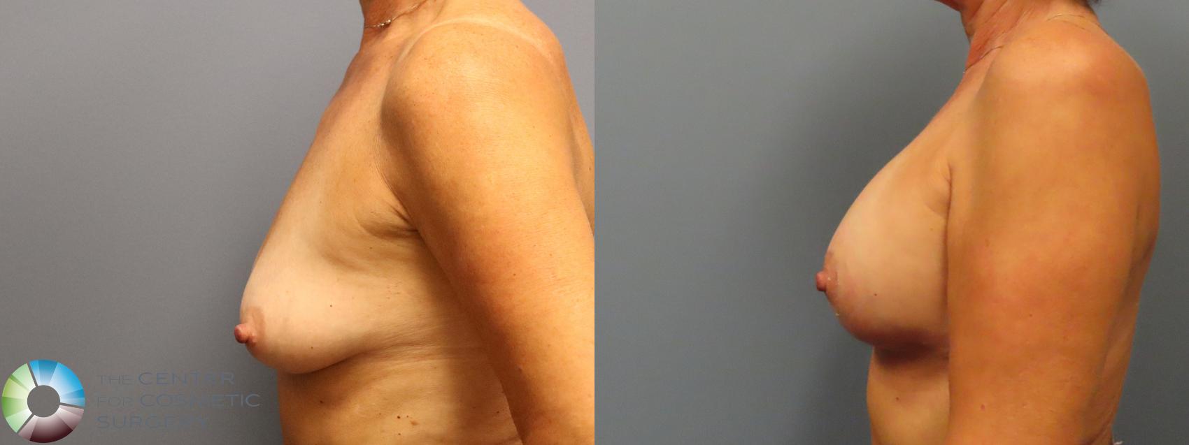 Before & After Breast Augmentation Case 11988 Left Side in Denver and Colorado Springs, CO