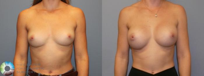 Before & After Breast Augmentation Case 11996 Front in Denver and Colorado Springs, CO