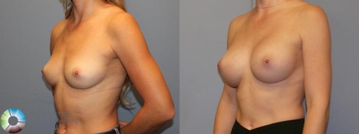 Before & After Breast Augmentation Case 11996 Left Oblique in Denver and Colorado Springs, CO