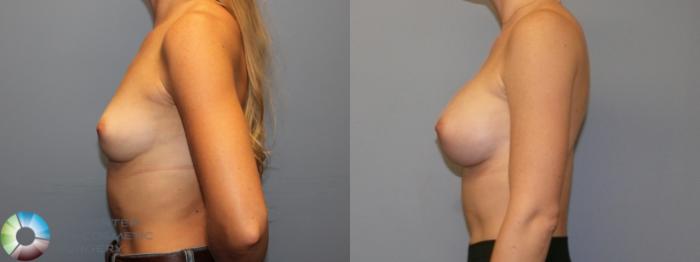 Before & After Breast Augmentation Case 11996 Left Side in Denver and Colorado Springs, CO
